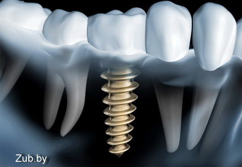 Можно ли поставить зубные импланты без наращивания кости?